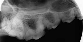 gingiviitti parodontiitti2